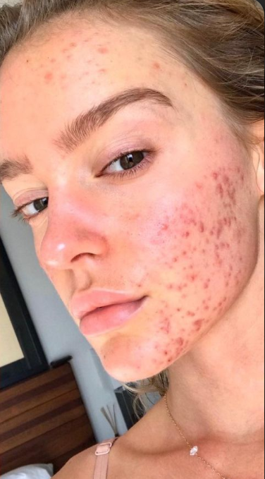 Neck skin after 1 week of use