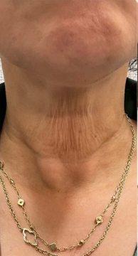 Neck skin after 1 week of use