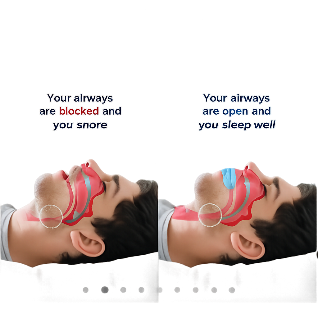 HushSleep™Anti-Snoring Mouthguard