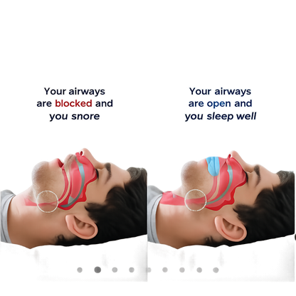 HushSleep™Anti-Snoring Mouthguard