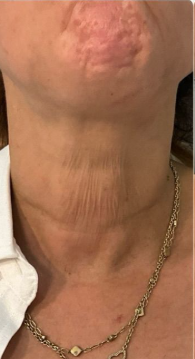 Neck skin after 2 weeks of use