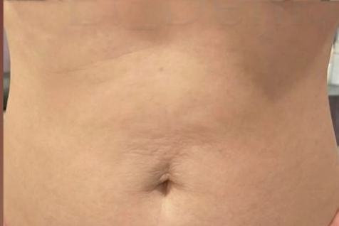 Neck skin after 2 weeks of use