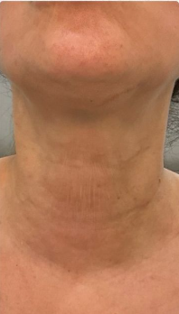 Neck skin after 1 month of use