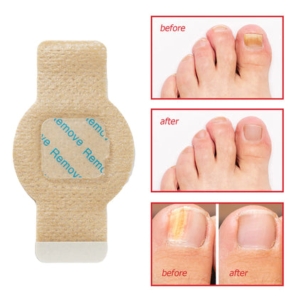 FungiCare Nail Repair Patches™