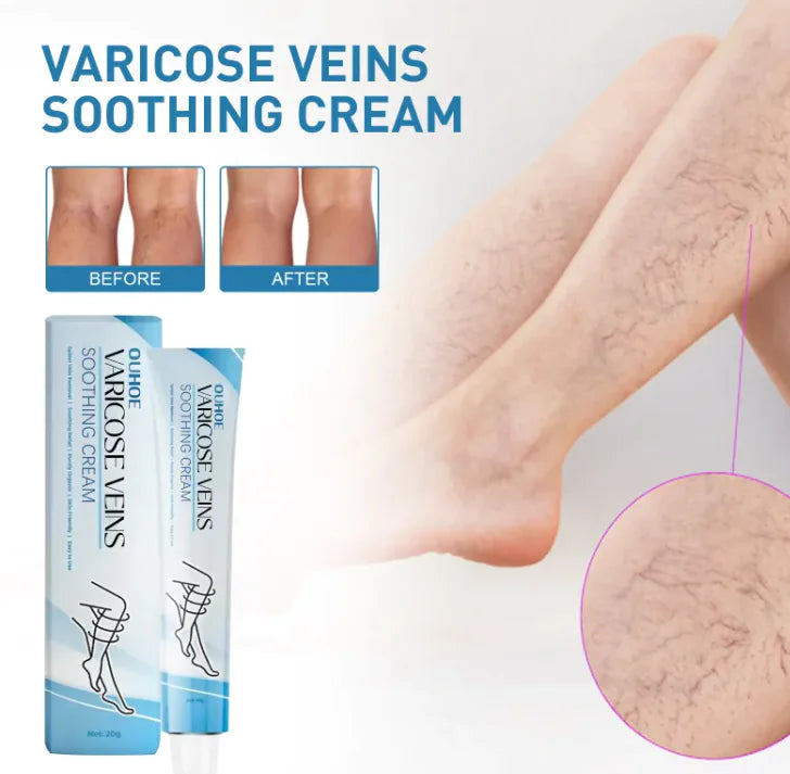 Varicose vain,Pain Relief Cream
