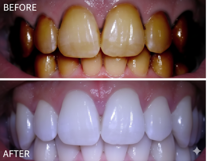 LumiDentTM,Teeth Whitening Powder