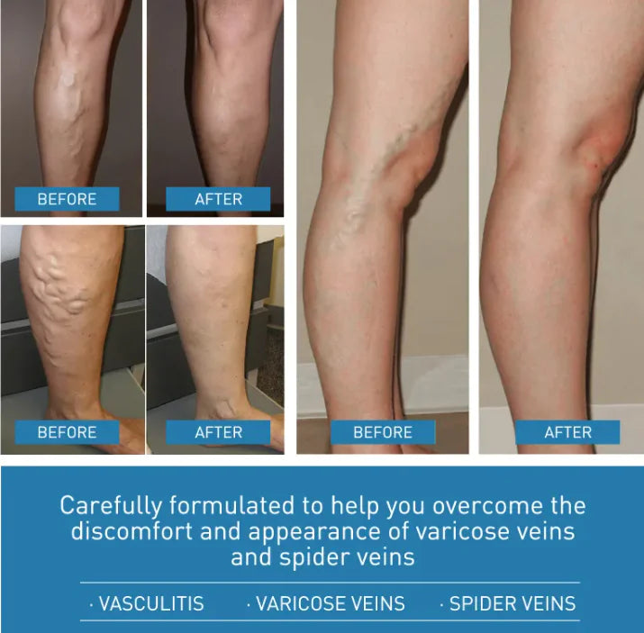 Varicose vain,Pain Relief Cream