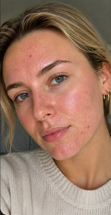 Neck skin after 1 week of use