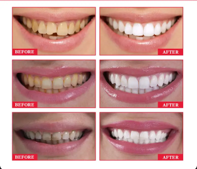 SwiftWhite™Tooth Cleaning Patch