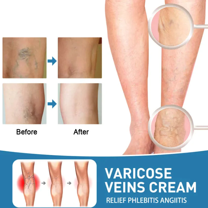 Varicose vain,Pain Relief Cream