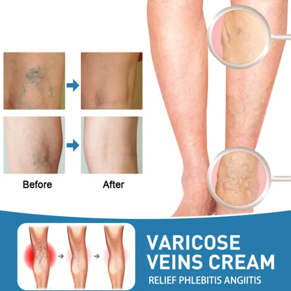 Varicose vain,Pain Relief Cream